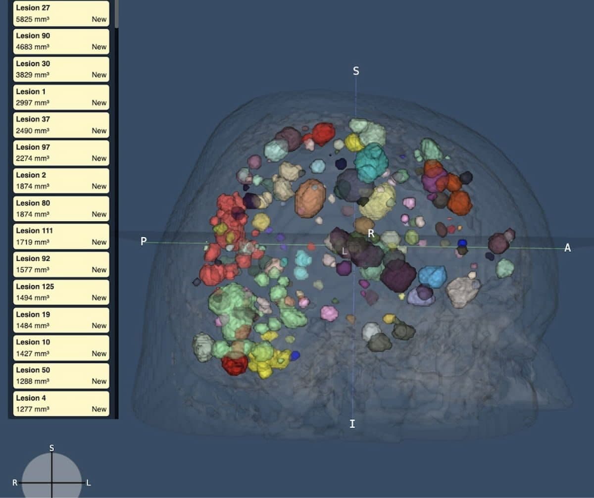 FDA Clears a Wave of AI Tools for Brain MRI Scans